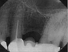 x-rays of teeth