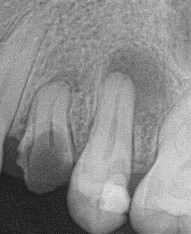 x-rays of teeth