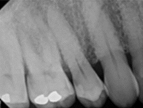 x-rays of teeth