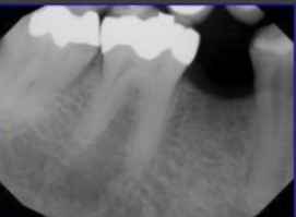 x-rays of teeth